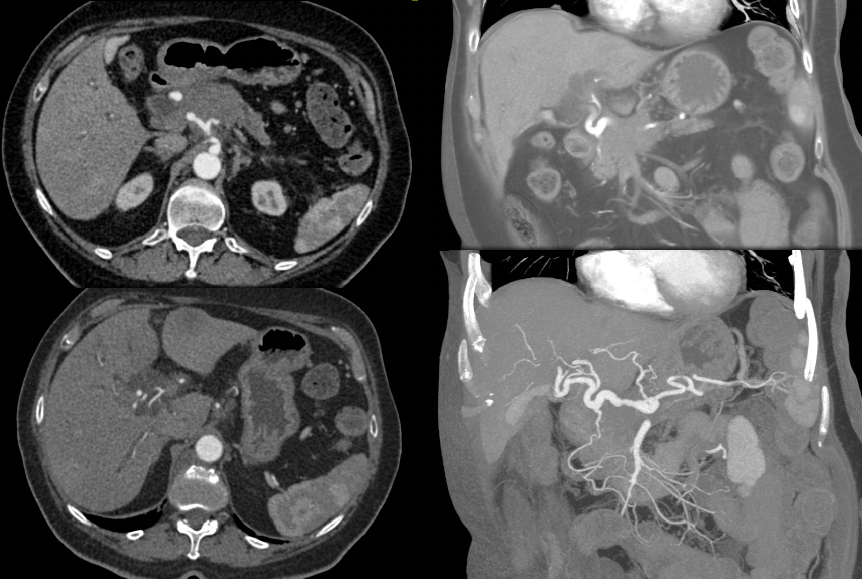 Adenocarcinoma