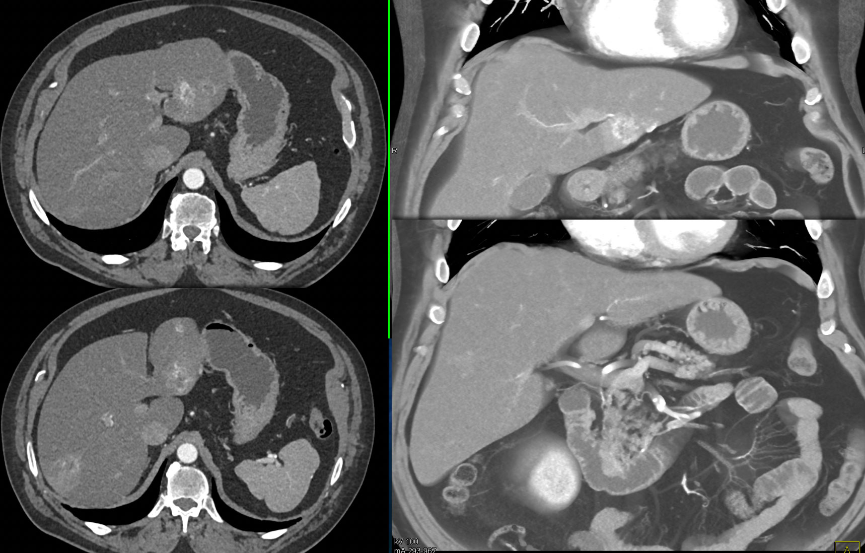 Duodenal Carcinoid Tumor