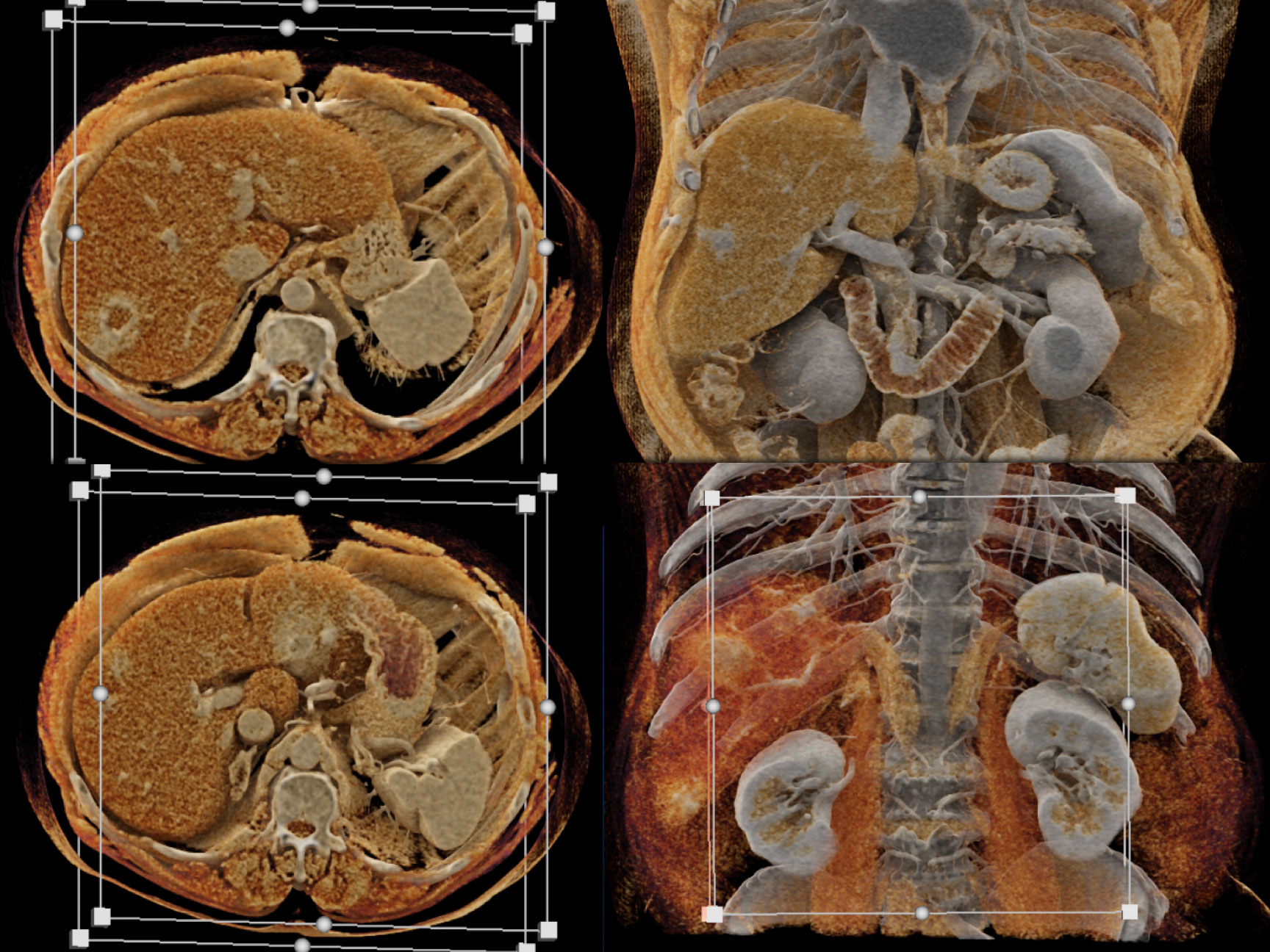 Vascular metastases