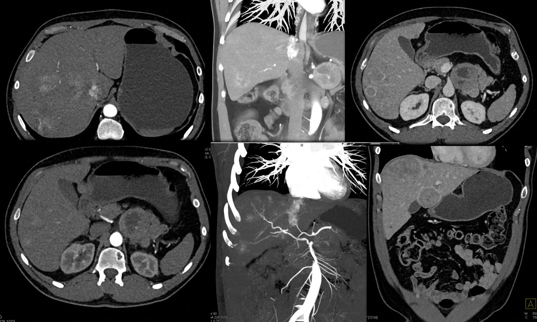 Neuroendocrine Tumor