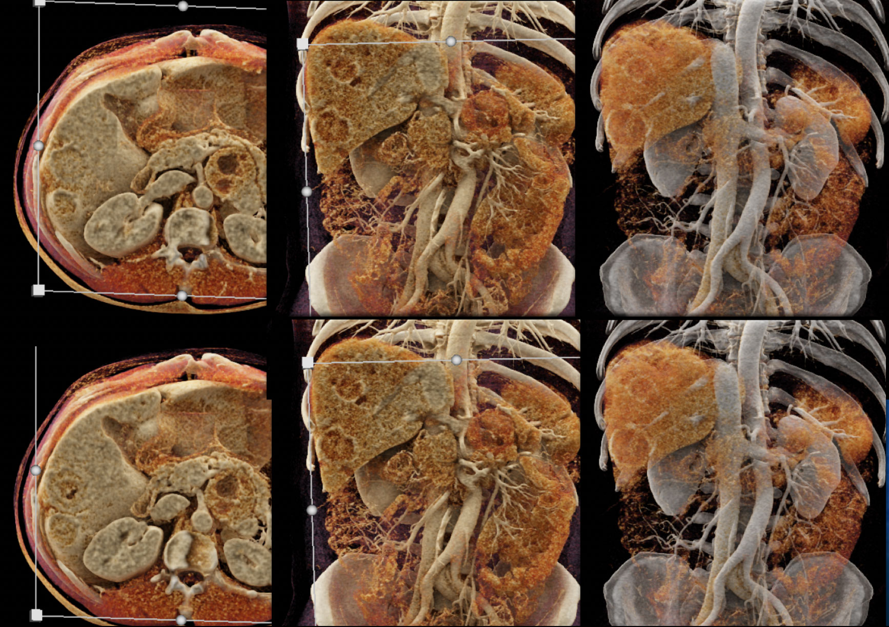 Liver Metastases