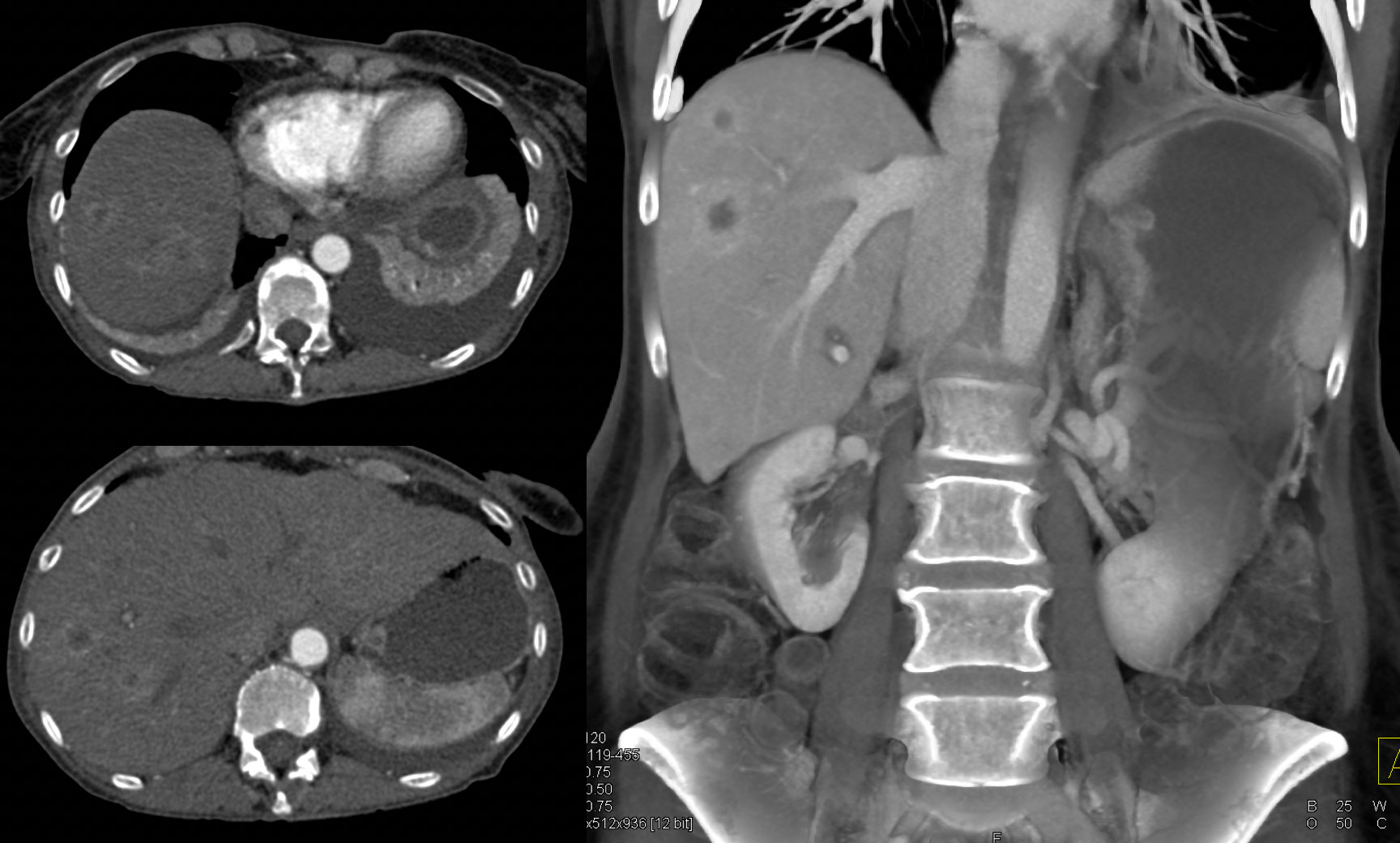 Adenosquammous Carcinoma