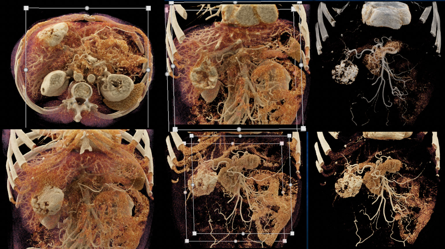 Hepatic Hemangioma