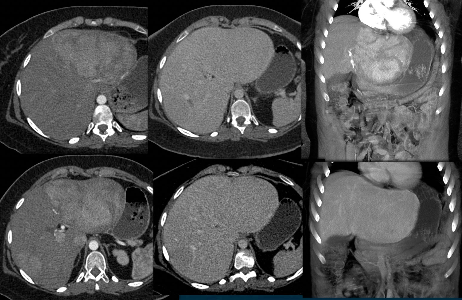 Hepatic Adenoma