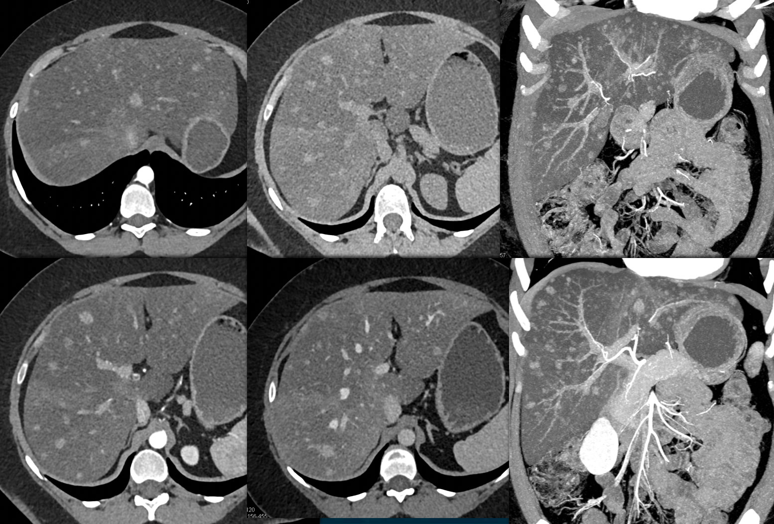 Hepatic Adenomas