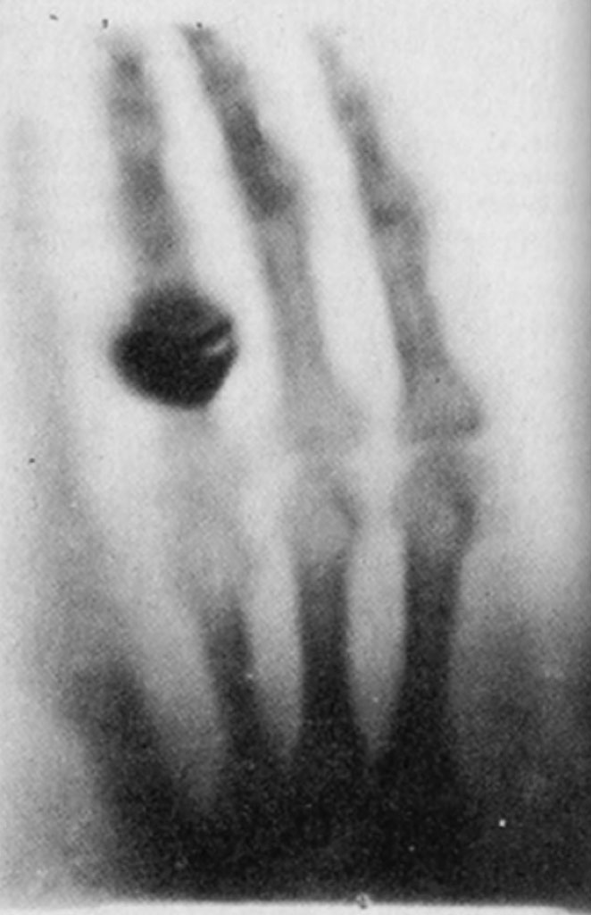 One of the first X-Rays