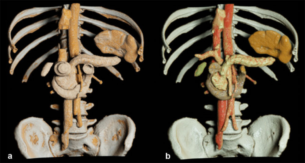 AI and CT Scanning