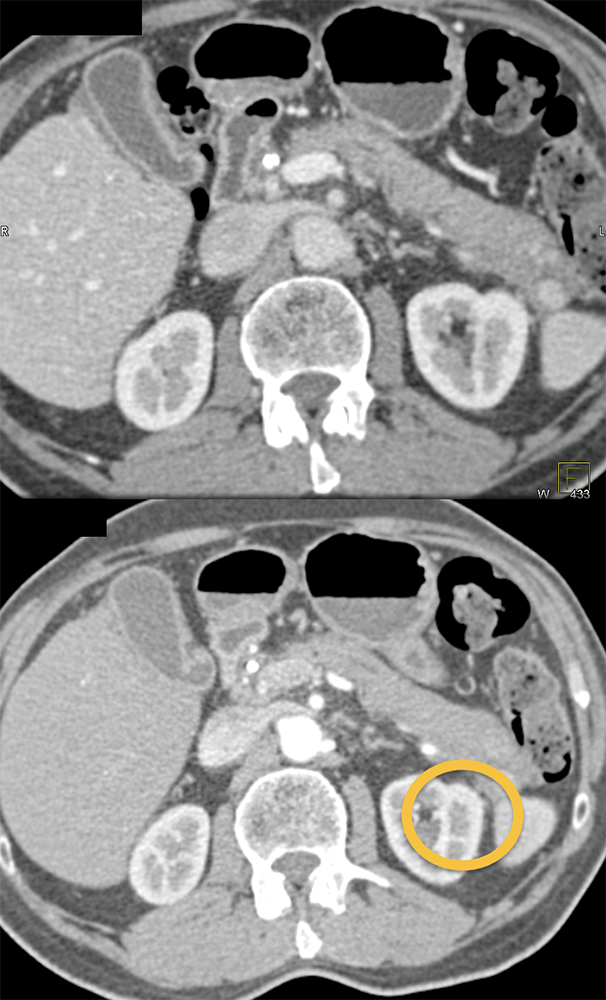 Islet Cell Tumor vs Splenic Tissue