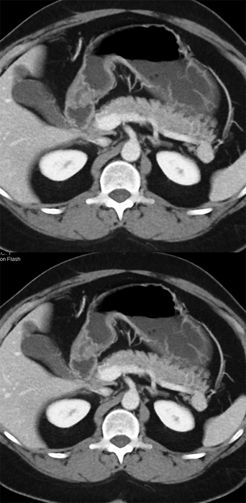 Accessory Spleen Near TOP