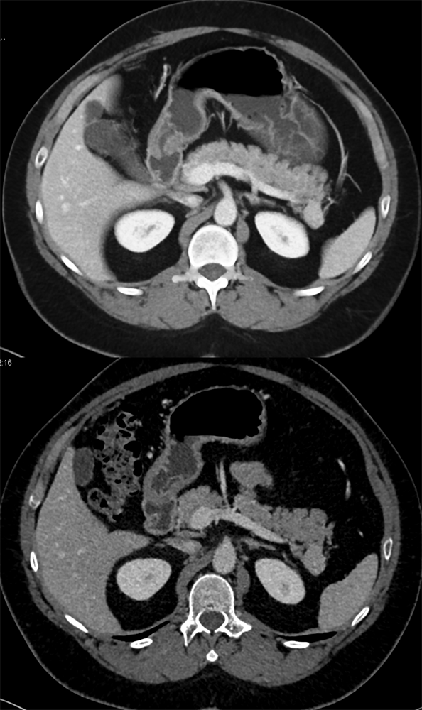 CT of Incidentalomas