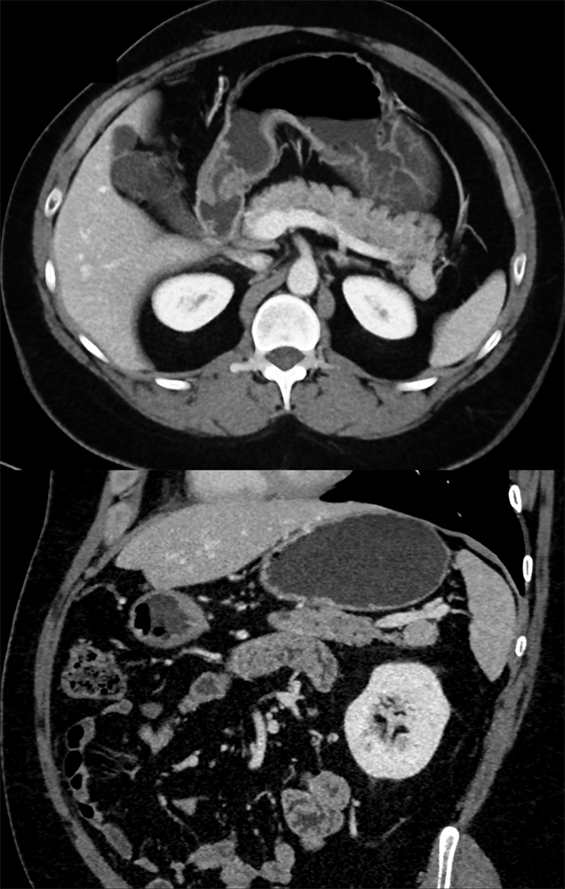 CT of Incidentalomas