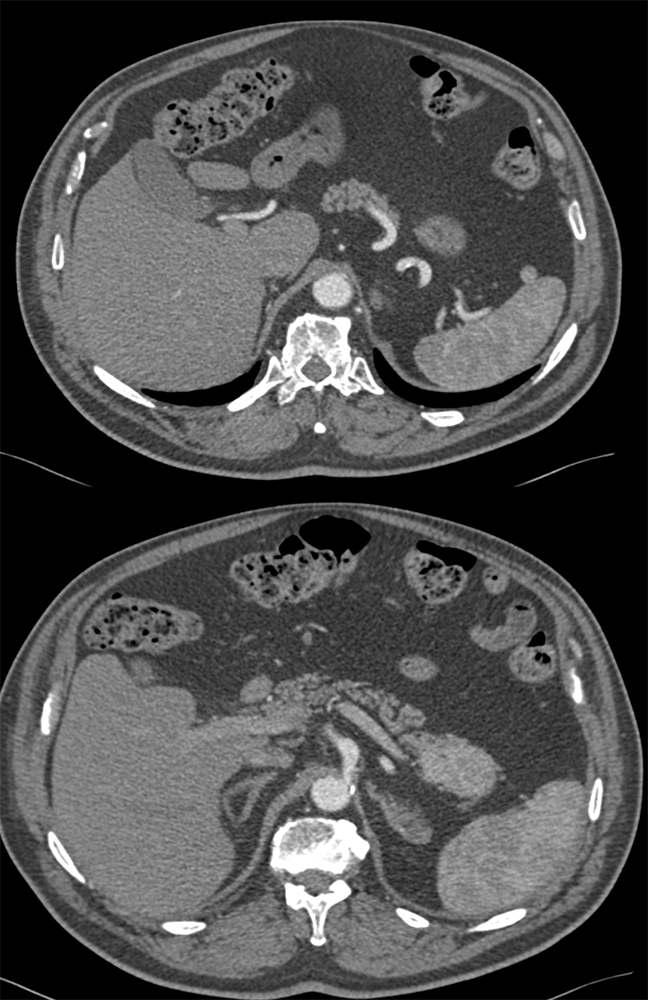 Splenosis Involves TOP (5 cm)