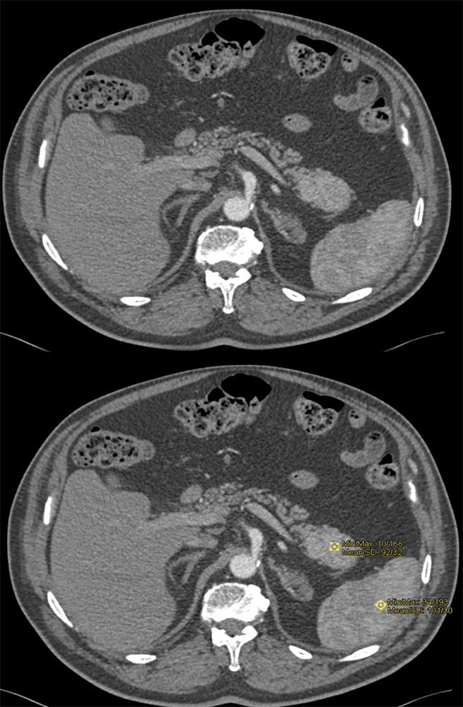 CT of Incidentalomas