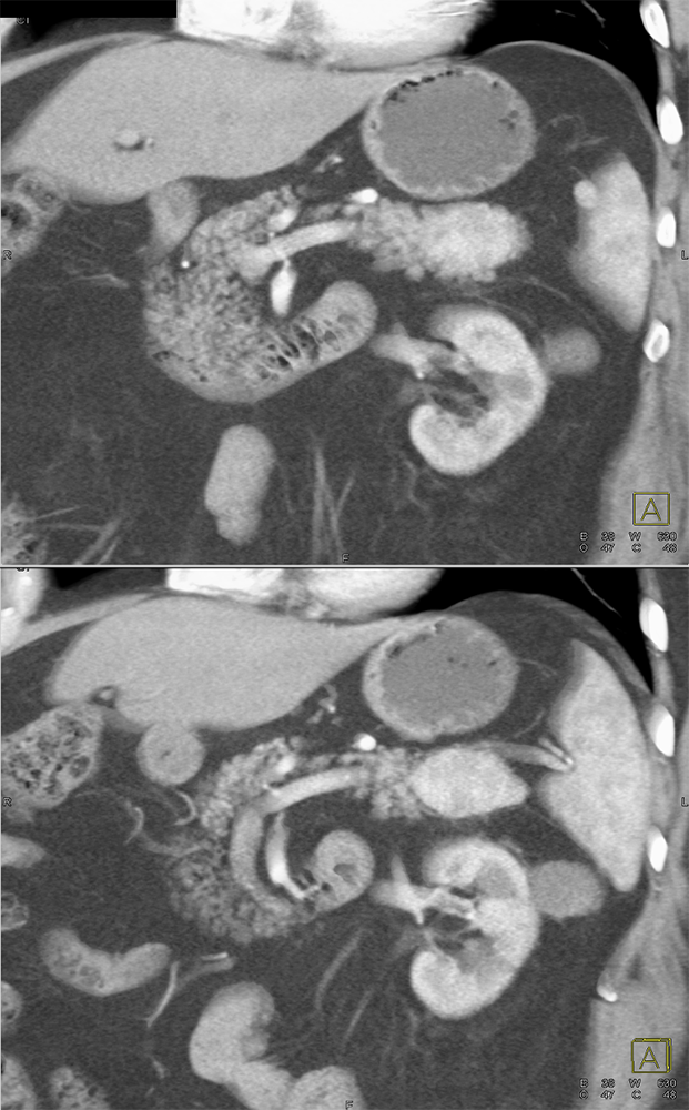 CT of Incidentalomas