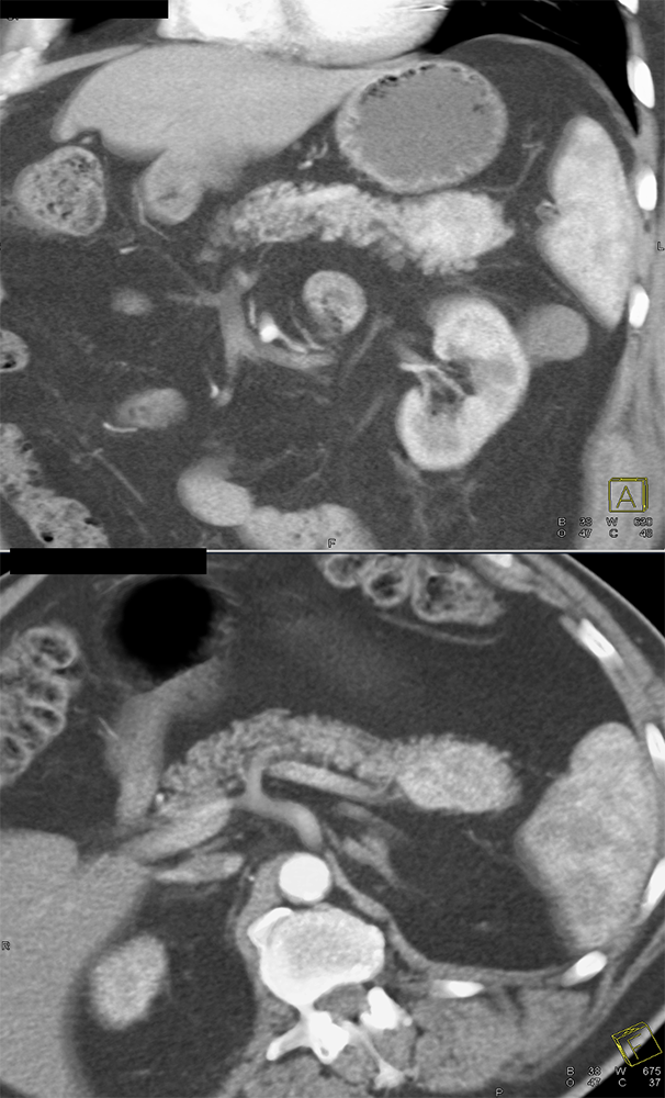 CT of Incidentalomas