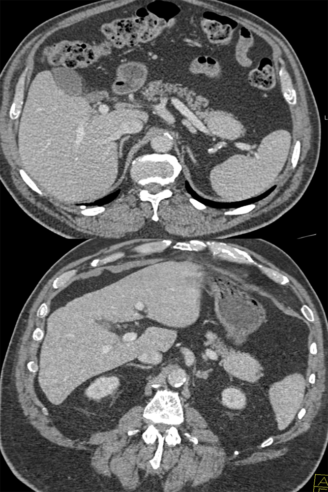 CT of Incidentalomas