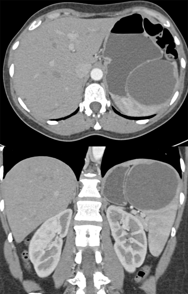 Splenic Cyst