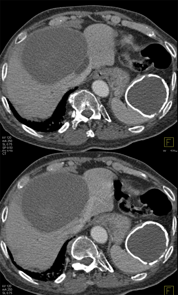 Splenic Cyst