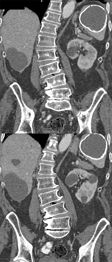 CT of Incidentalomas