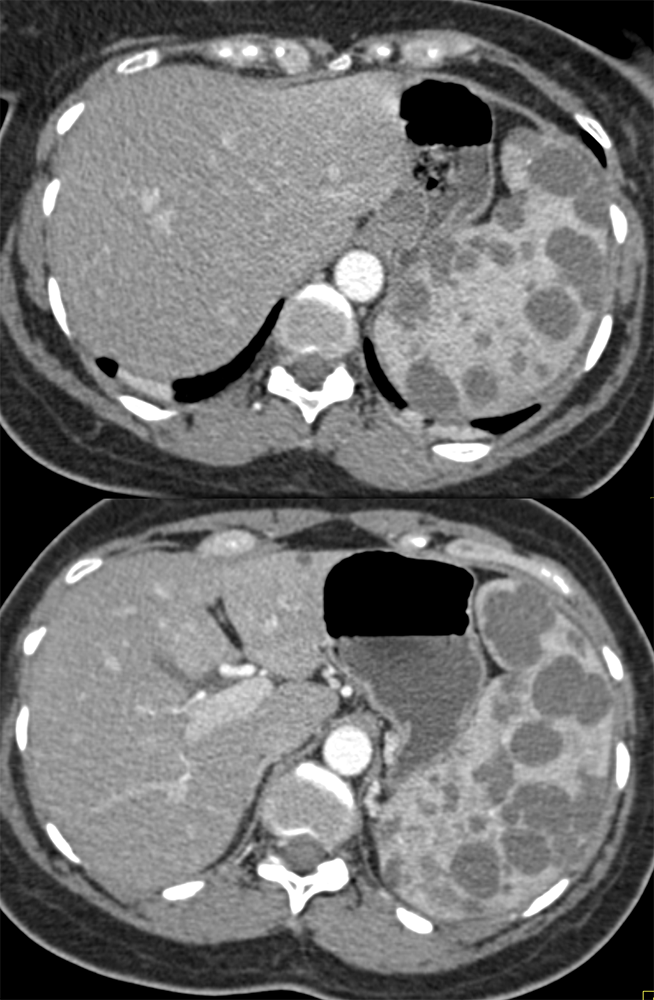 Splenic Cysts