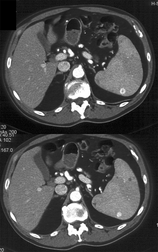 Splenic Hemangioma