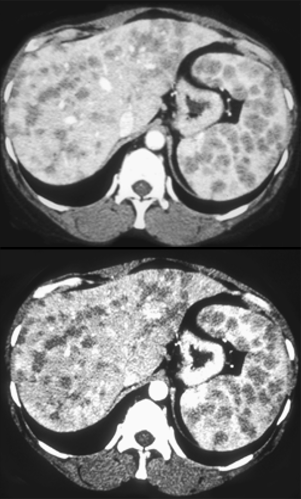 Sarcoidosis