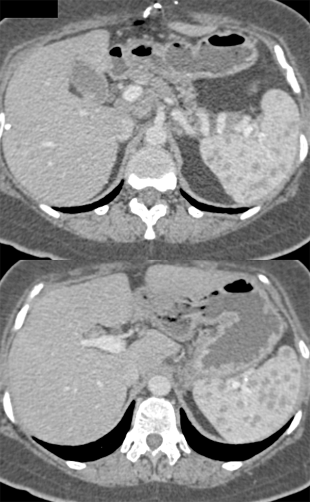 Sarcoidosis Spleen