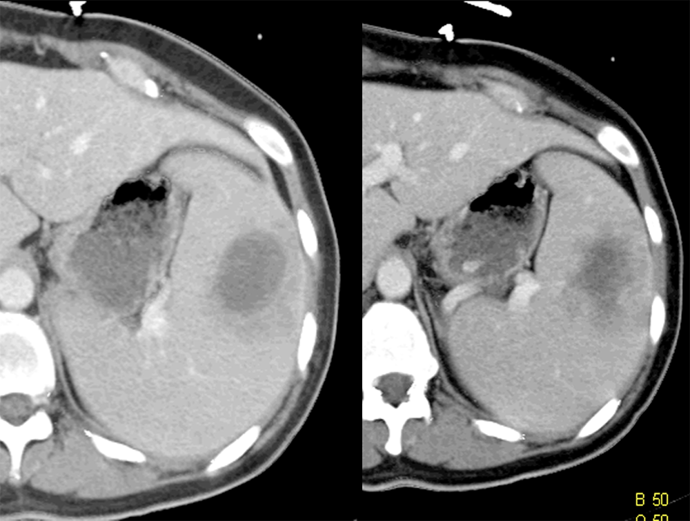 Splenic Abscess