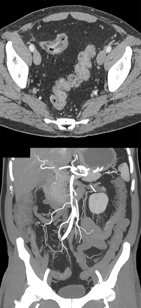 Crohn’s with High Grade Dysplasia in Terminal Ileum