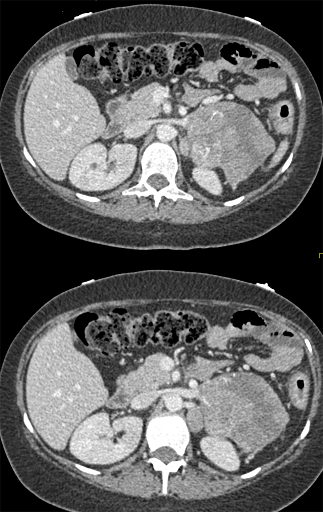 Adrenal Carcinoma in Patient with Ulcerative Colitis