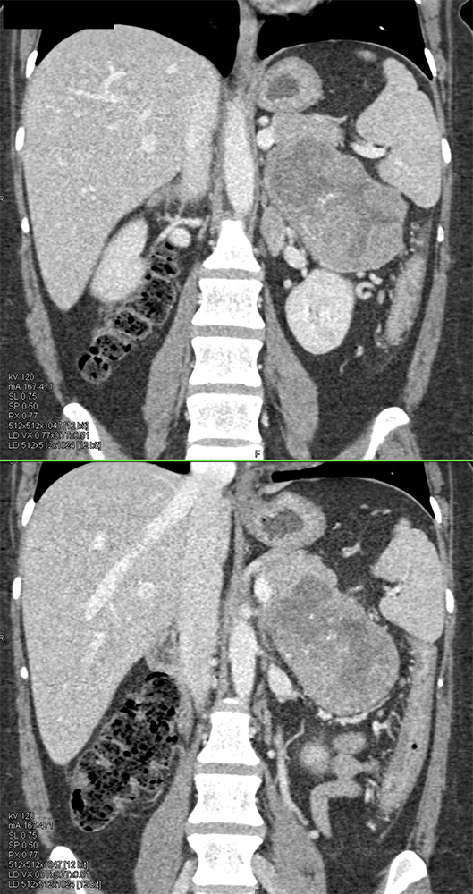 Large Adrenal Masses