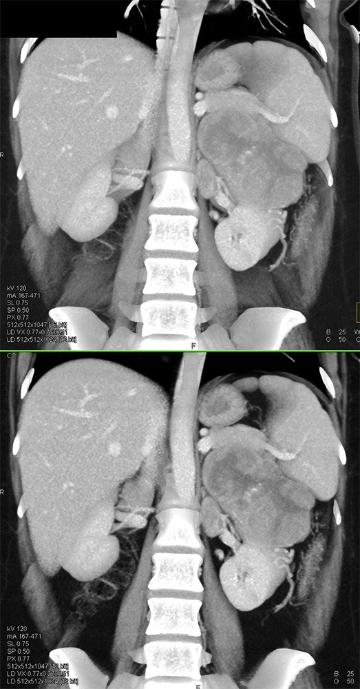 Large Adrenal Masses