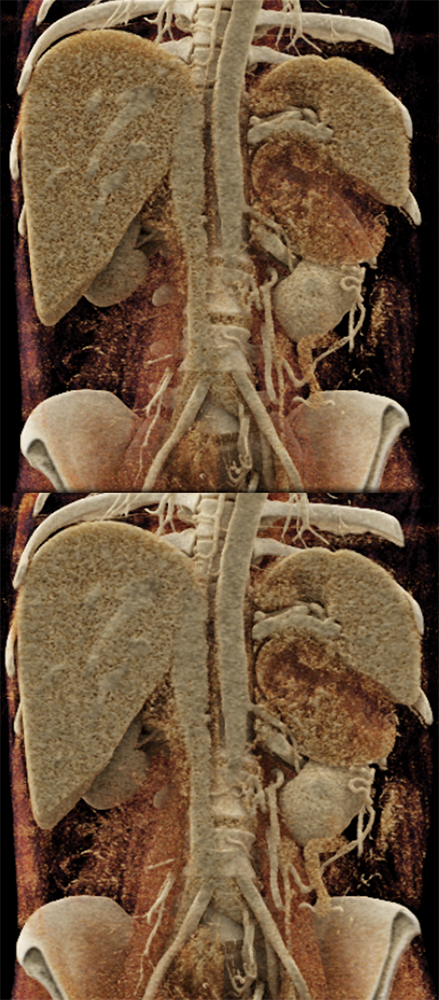 Large Adrenal Masses