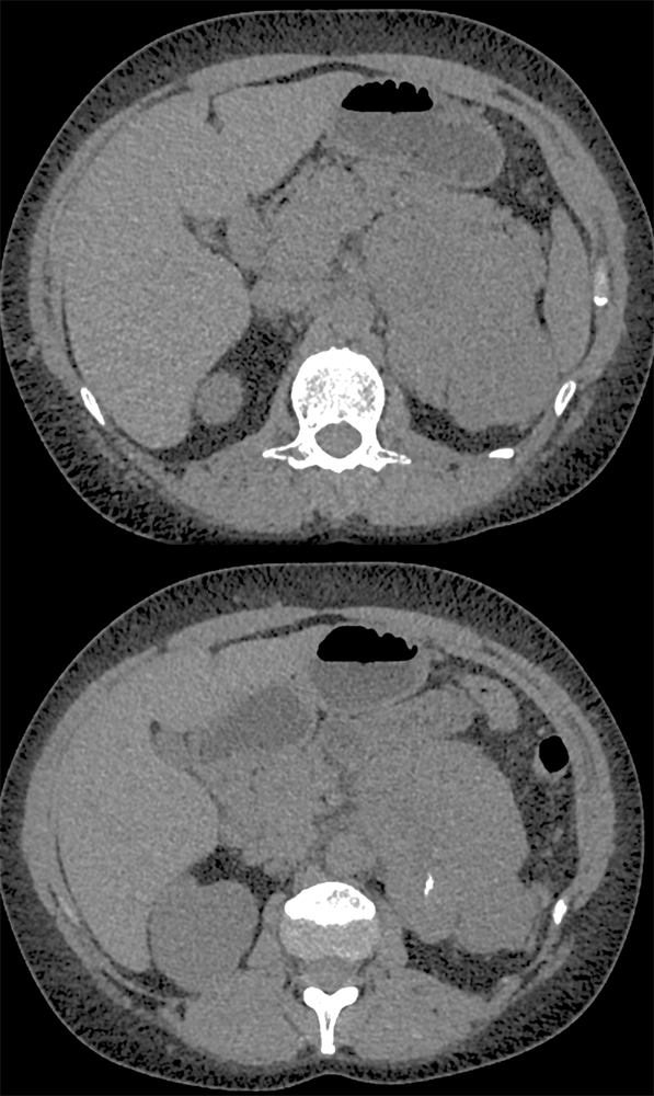 Primary Adrenal Carcinoma with Positive Nodes. Presented with Cushings Syndrome