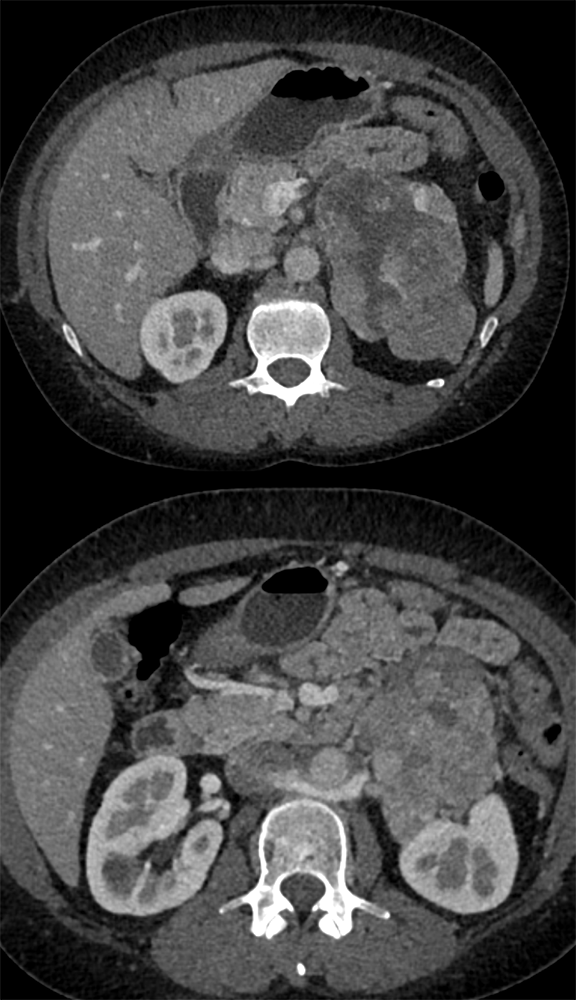 Large Adrenal Masses