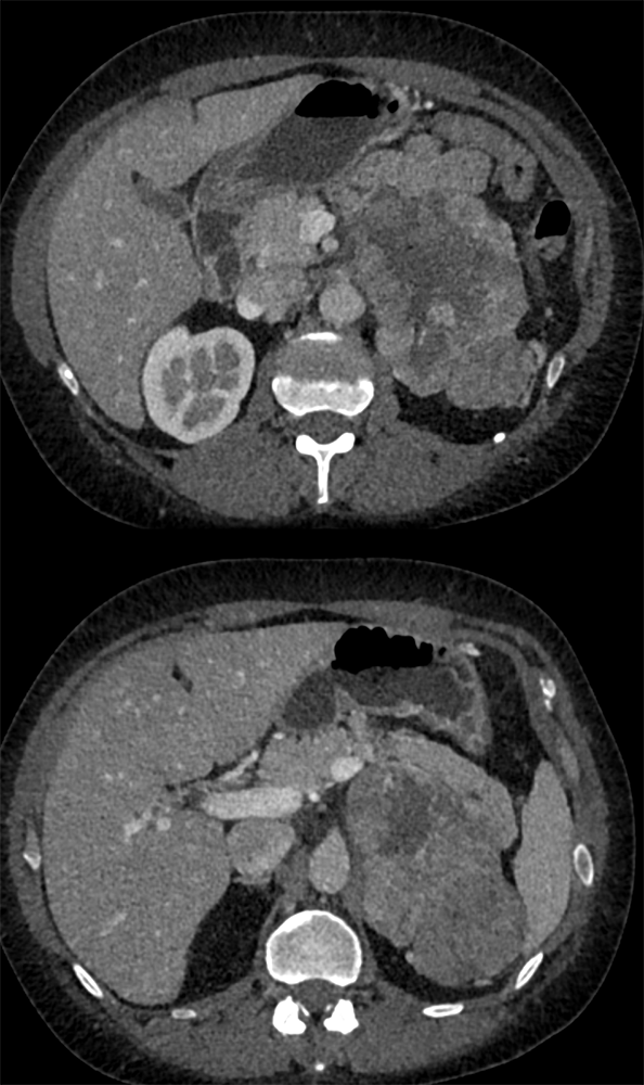 Large Adrenal Masses