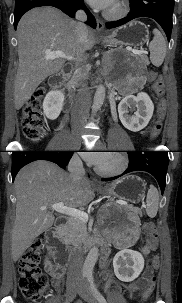 Large Adrenal Masses