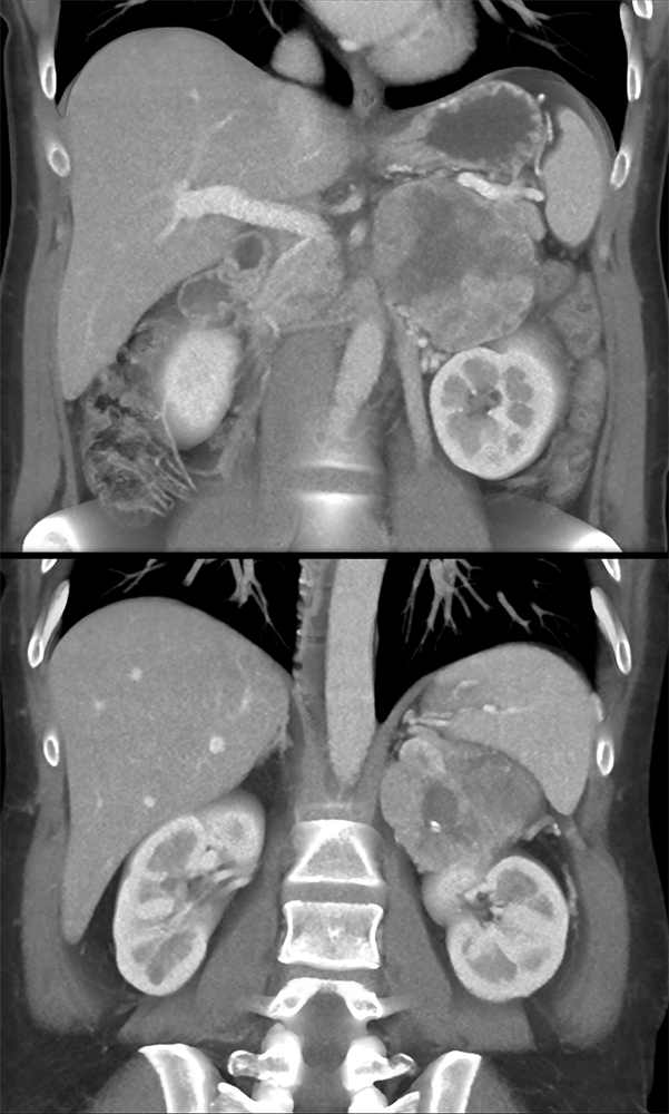 Large Adrenal Masses