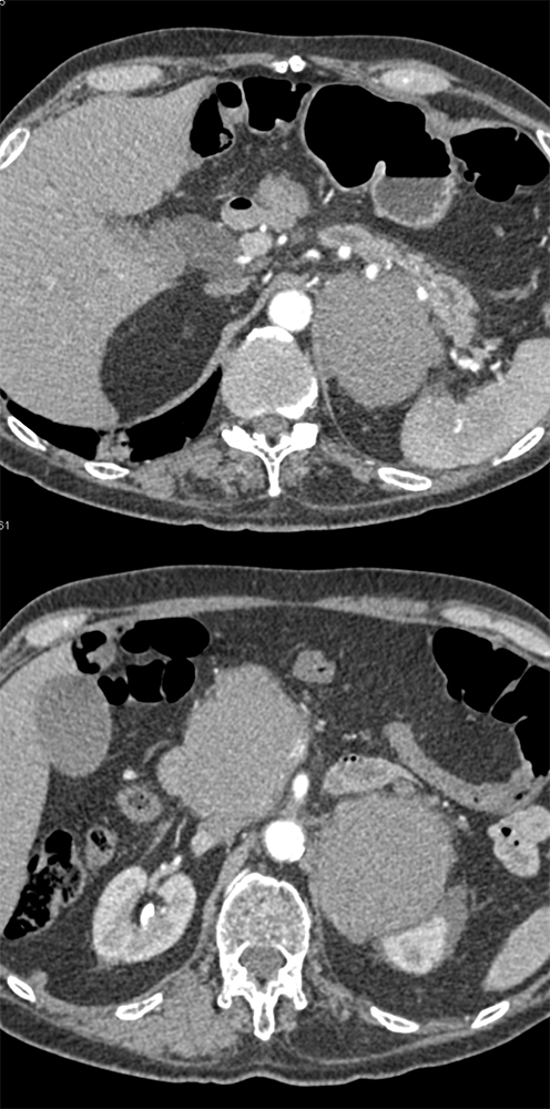 Follicular Lymphoma