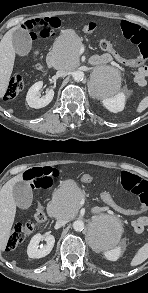 Large Adrenal Masses