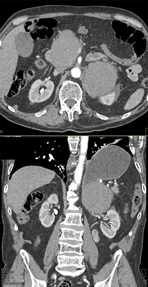 Large Adrenal Masses