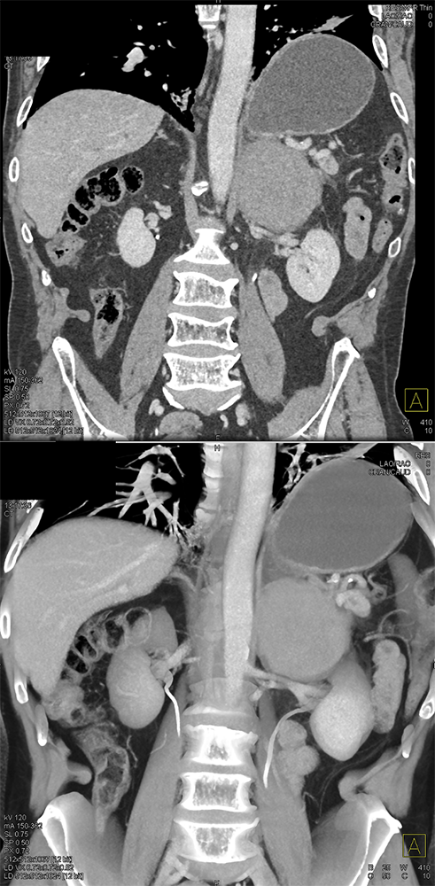 Large Adrenal Masses