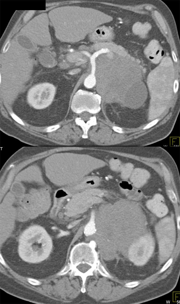 Primary Lymphoma of the Adrenal Gland