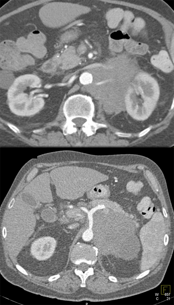 Large Adrenal Masses