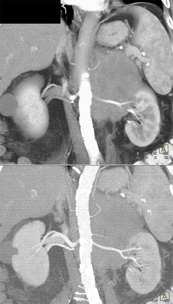 Large Adrenal Masses