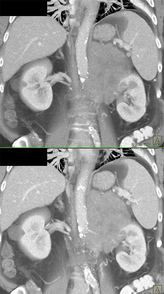 Large Adrenal Masses