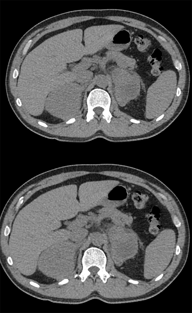 Abdominal Pain and FUO