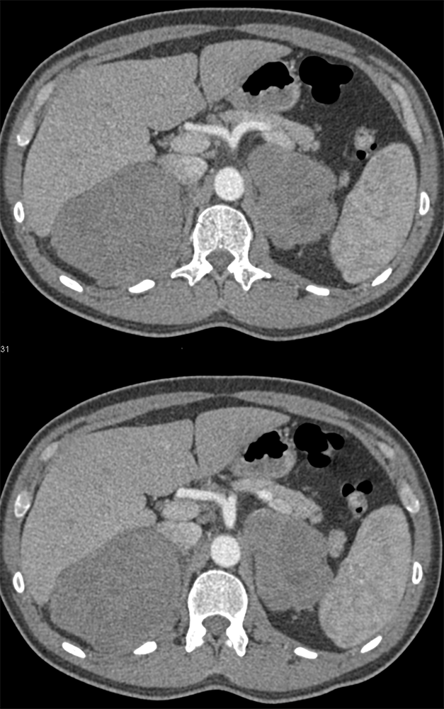 Large Adrenal Masses