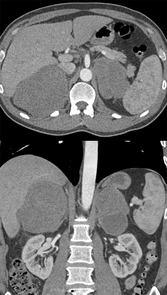 Large Adrenal Masses