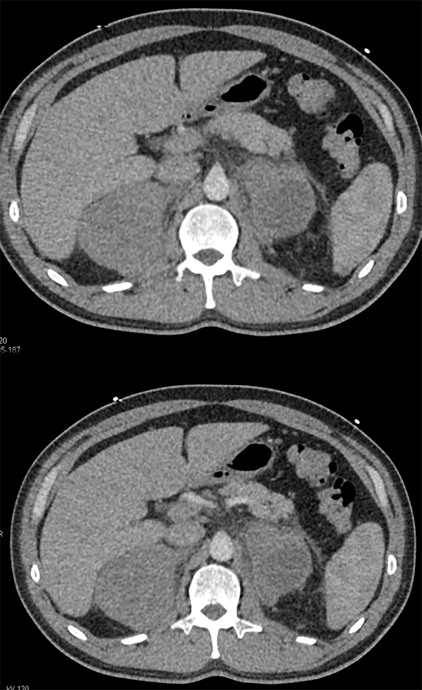 Large Adrenal Masses